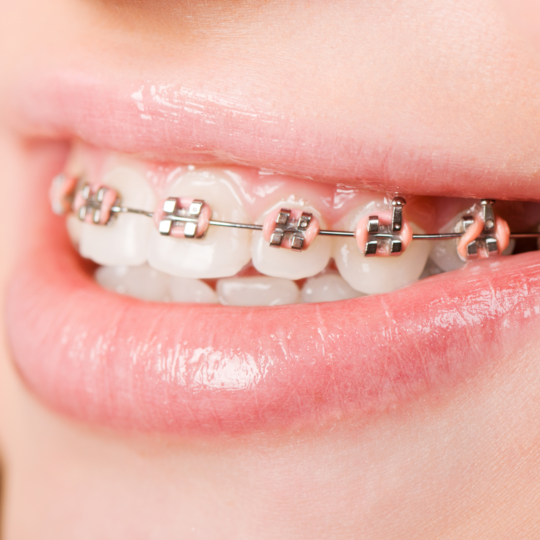 Can You Wear Braces if You Have Fillings?